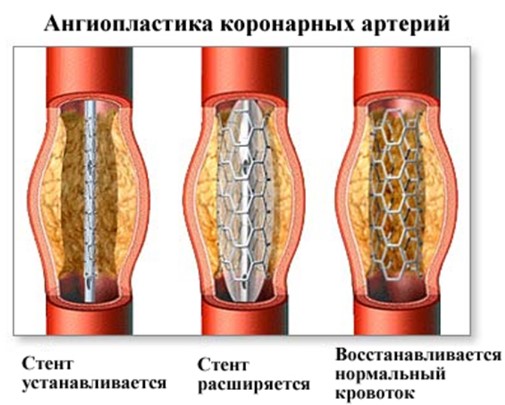 Реваскуляризация миокарда коронарная. Что это такое