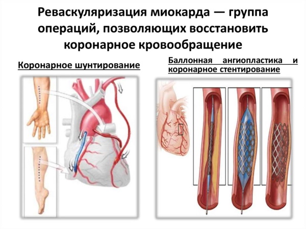 Реваскуляризация миокарда коронарная. Что это такое