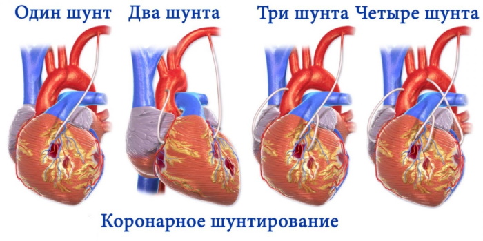 Реваскуляризация миокарда коронарная. Что это такое