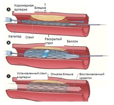 Реваскуляризация миокарда коронарная. Что это такое