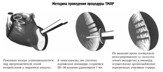 Реваскуляризация миокарда коронарная. Что это такое