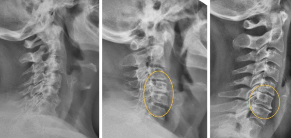 Спондилез шейного отдела позвоночника. Что это такое, лечение