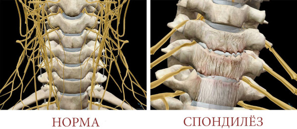 Спондилез шейного отдела позвоночника. Что это такое, лечение