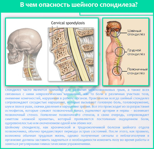 Спондилез шейного отдела позвоночника. Что это такое, лечение