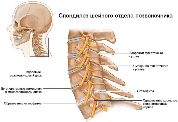 Спондилез шейного отдела позвоночника. Что это такое, лечение