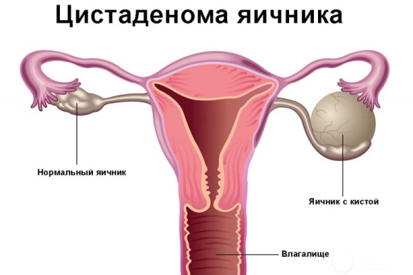 Цистаденома яичника. Что это такое, симптомы, причины, лечение