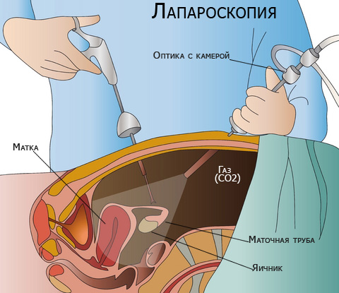 Фолликулярная киста яичника на УЗИ. Что делать, что это