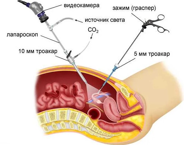 Цистаденома яичника. Что это такое, симптомы, причины, лечение