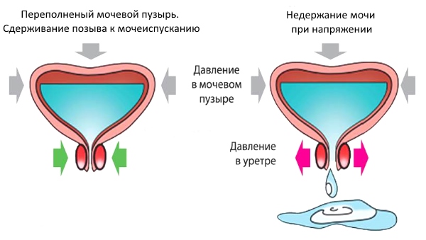 Цистит у детей. Симптомы и лечение в домашних условиях