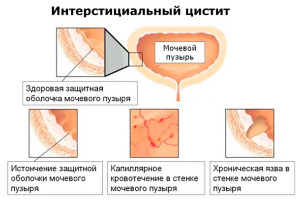 Заболевания мочевыделительной системы у женщин. Симптомы и лечение