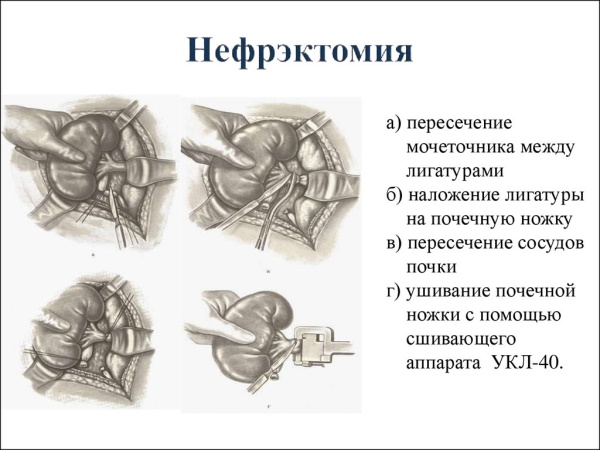 Заболевания мочевыделительной системы у женщин. Симптомы и лечение