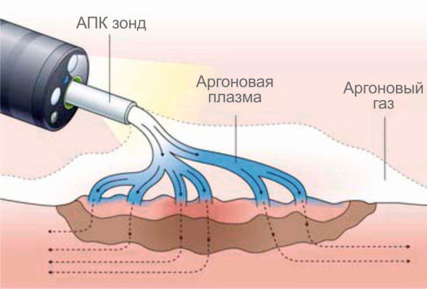 Заболевания прямой кишки. Классификация, симптомы, признаки