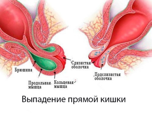 Заболевания прямой кишки. Классификация, симптомы, признаки