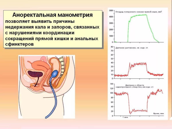 Заболевания прямой кишки. Классификация, симптомы, признаки