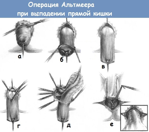 Заболевания прямой кишки. Классификация, симптомы, признаки