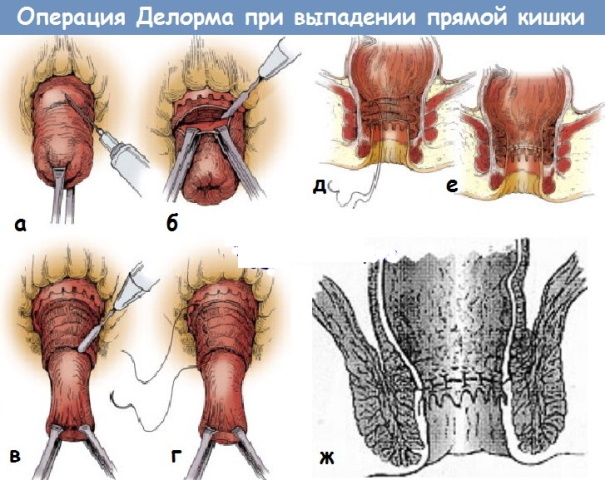 Заболевания прямой кишки. Классификация, симптомы, признаки