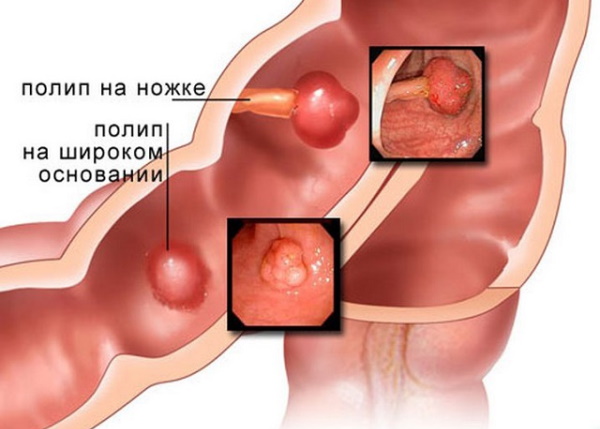 Заболевания прямой кишки. Классификация, симптомы, признаки