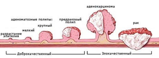 Заболевания прямой кишки. Классификация, симптомы, признаки