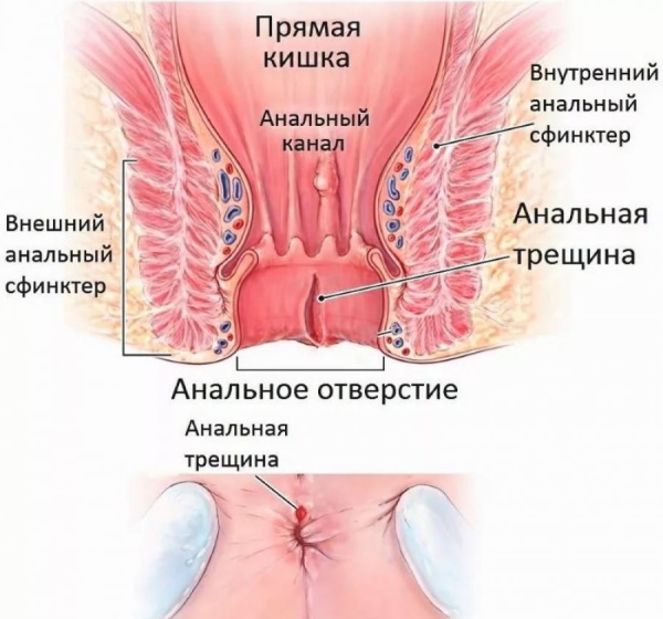 Заболевания прямой кишки. Классификация, симптомы, признаки