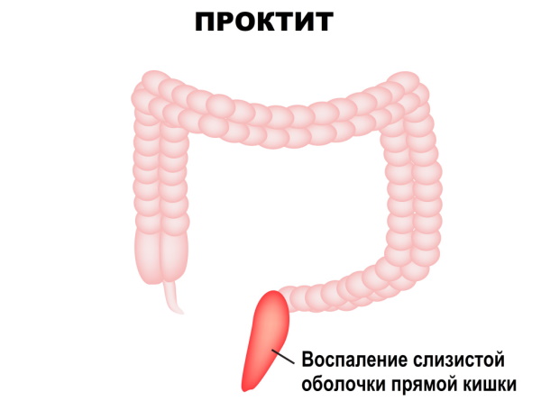 Заболевания прямой кишки. Классификация, симптомы, признаки