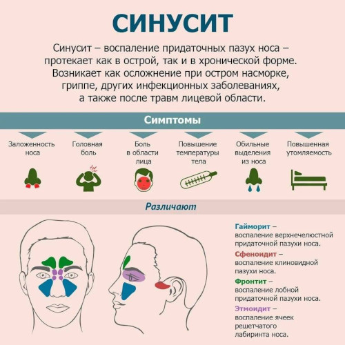 Аллергический синусит (риносинусопатия, риносинусит). Лечение, симптомы