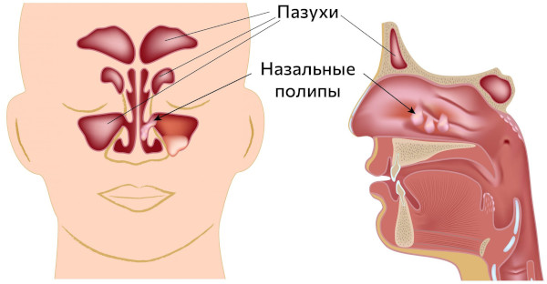 Аллергический синусит (риносинусопатия, риносинусит). Лечение, симптомы