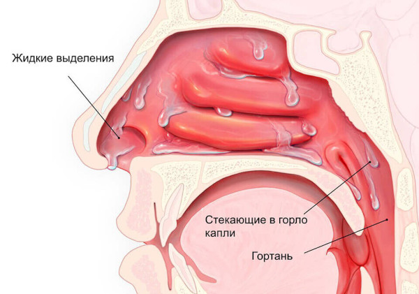 Аллергический синусит (риносинусопатия, риносинусит). Лечение, симптомы