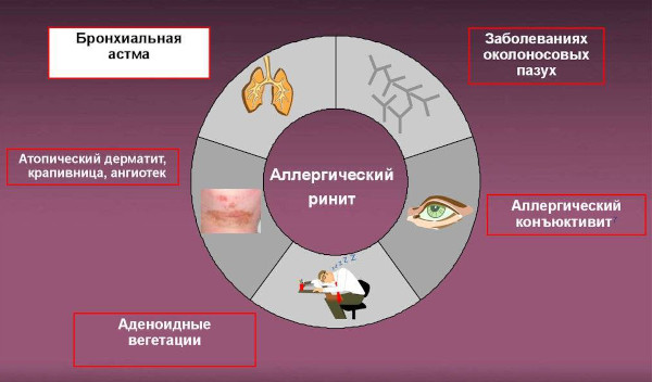 Аллергический синусит (риносинусопатия, риносинусит). Лечение, симптомы