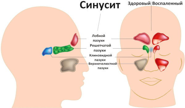 Аллергический синусит (риносинусопатия, риносинусит). Лечение, симптомы