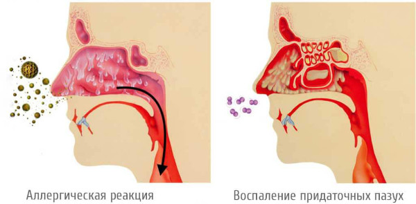 Аллергический синусит (риносинусопатия, риносинусит). Лечение, симптомы