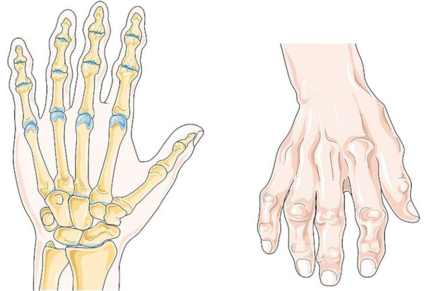 Артроз кистей рук. Фото, симптомы, лечение, гимнастика