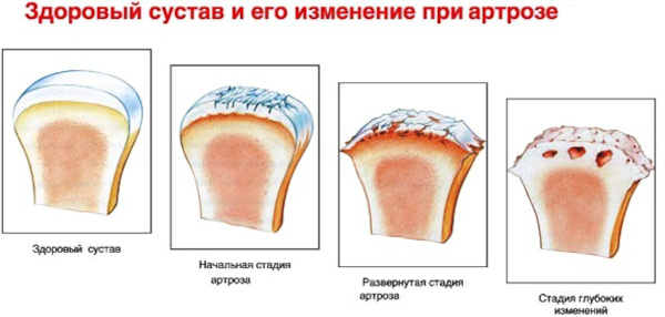 Артроз кистей рук. Фото, симптомы, лечение, гимнастика