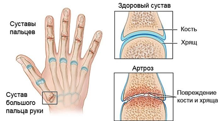 Артроз пальцев рук. Лечение: гимнастика, мази, таблетки