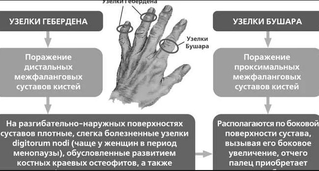 Артроз пальцев рук. Лечение: гимнастика, мази, таблетки