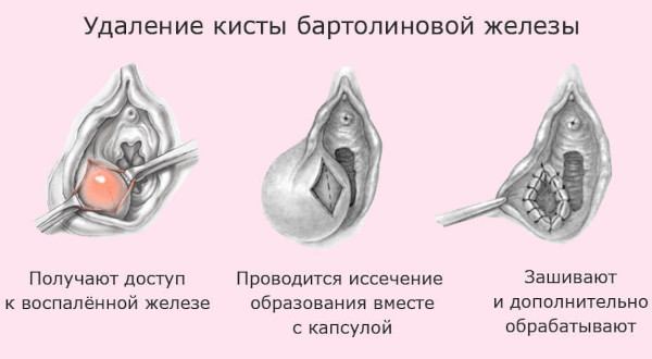 Бартолинит. Лечение в домашних условиях, мази, антибиотики