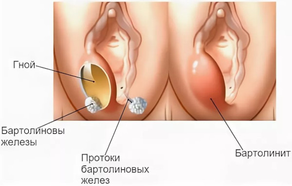 Бартолинит. Лечение в домашних условиях, мази, антибиотики