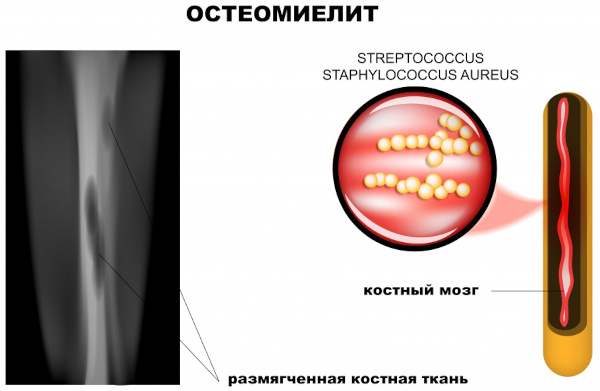 Боли в ногах: ноют от колена до ступни. Причины