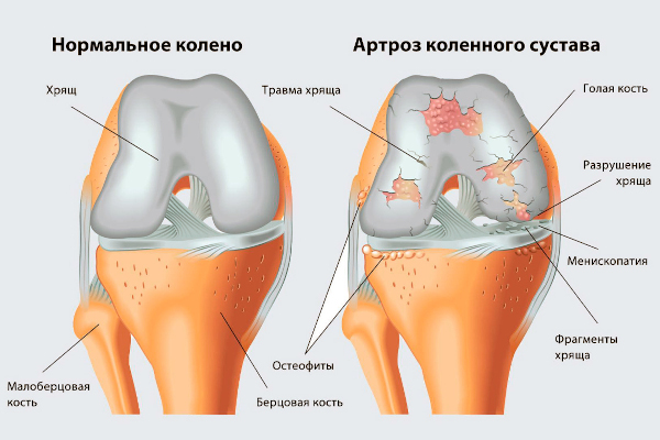 Боли в ногах: ноют от колена до ступни. Причины