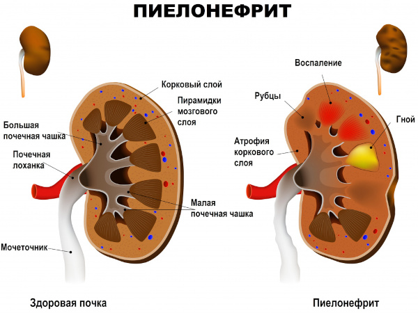 Диета при пиелонефрите у детей. Стол, памятка