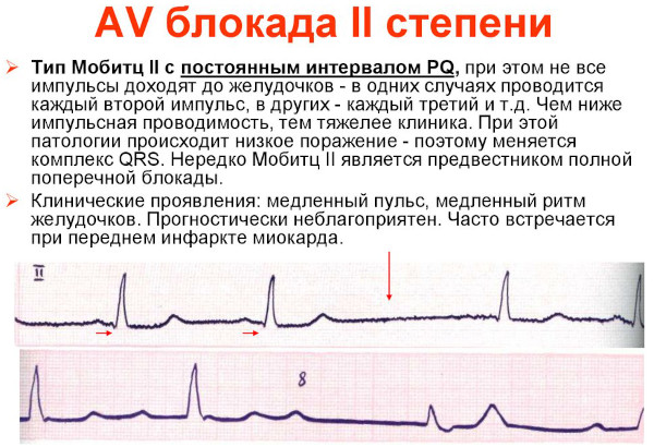 Дигоксин (Digoxin). Показания к применению, противопоказания