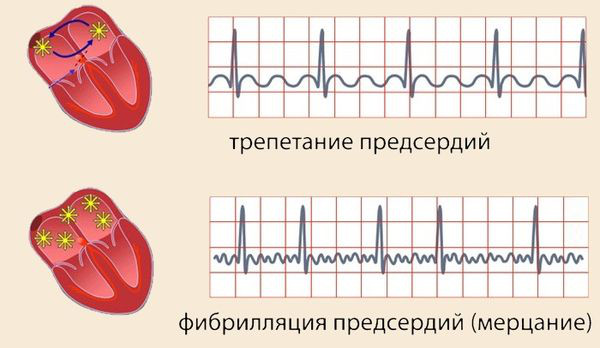 Дигоксин (Digoxin). Показания к применению, противопоказания