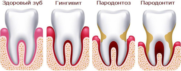 Экзостоз челюсти. Фото, что это, причины, лечение