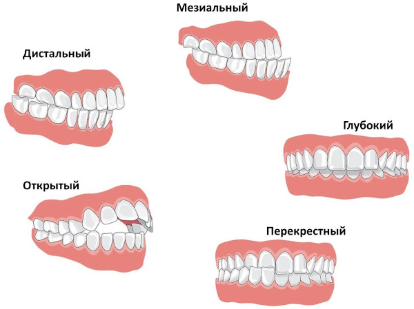 Экзостоз челюсти. Фото, что это, причины, лечение