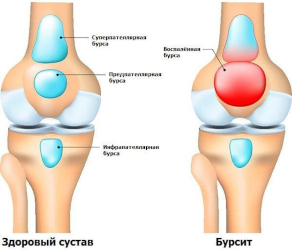 Экзостоз костно-хрящевой ткани. Лечение, что это такое