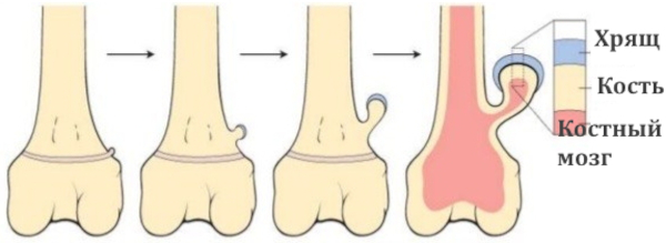 Экзостоз костно-хрящевой ткани. Лечение, что это такое