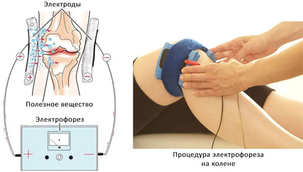 Экзостоз костно-хрящевой ткани. Лечение, что это такое