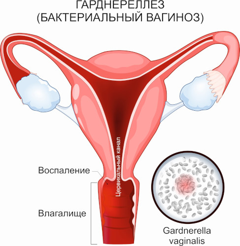 Гарднереллез у женщин. Свечи, препараты, схема лечения