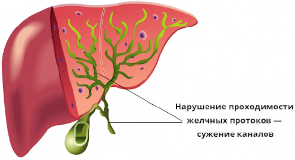 Холецистит бескаменный хронический. Cимптомы и лечение