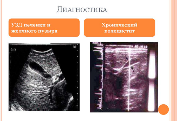 Холецистит бескаменный хронический. Cимптомы и лечение