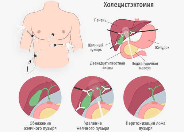 Холецистит бескаменный хронический. Cимптомы и лечение